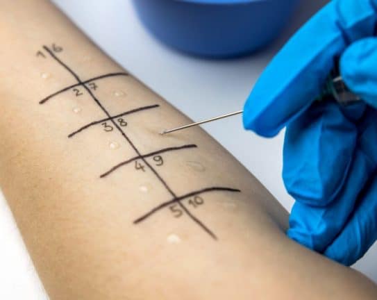 teste-alergologice-cutanate