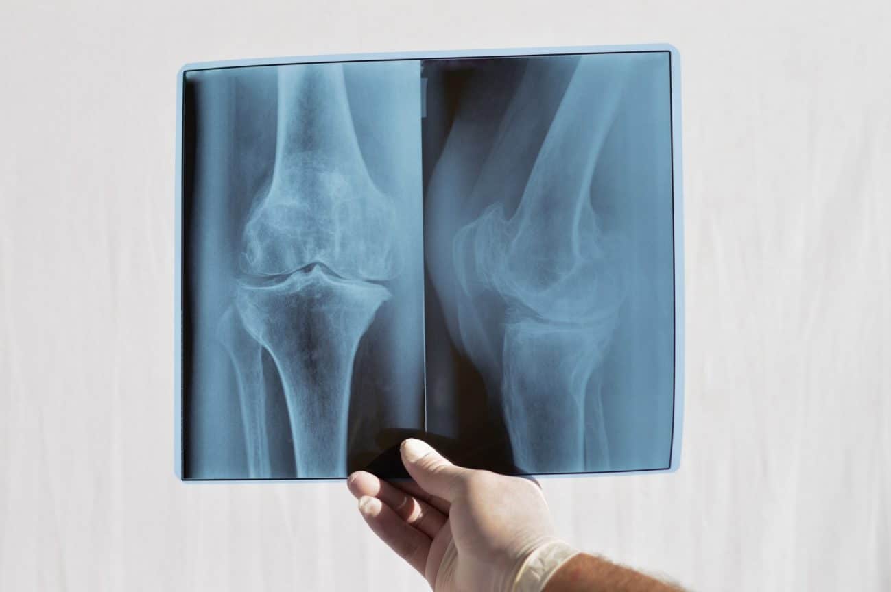 Radiografia de genunchi: cum arată procedura la clinica Medikali și cum te pregătești pentru ea