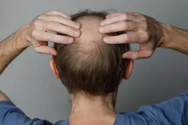 barbat cu alopecie androgenetica